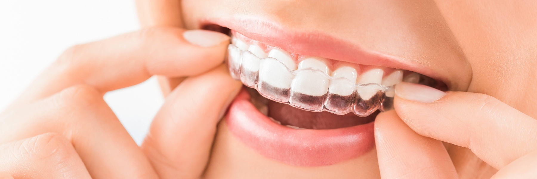 Invisalign | Dentist