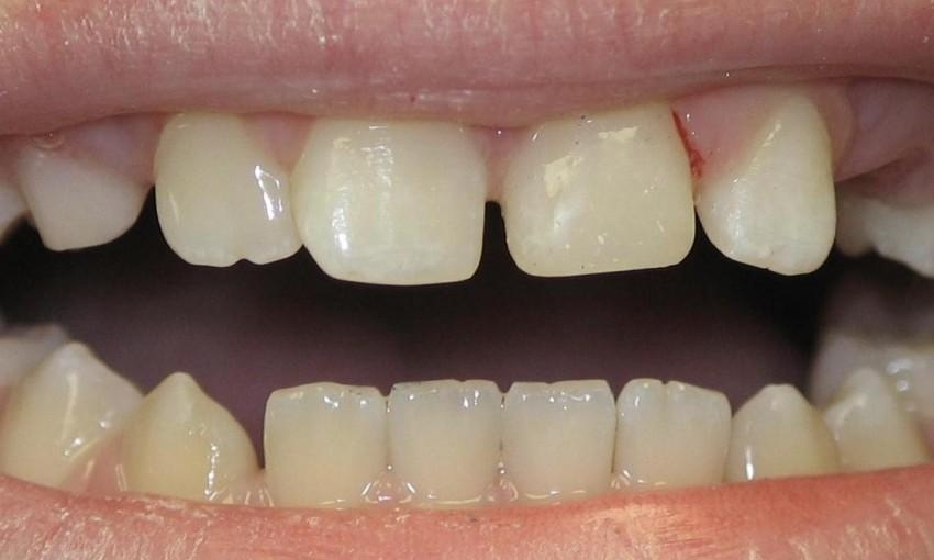 Before & After Photos, Cracked Tooth Repair Gallery