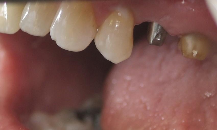 Crown and Implant Crown Restoration Before & After Photos St Louis