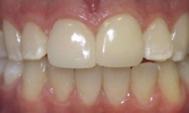 Composite-Veneers-After-Image
