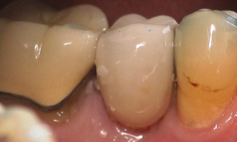 Implant-Replacement-After-Image