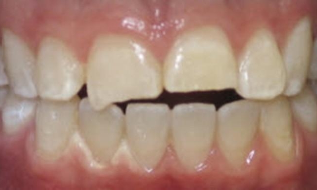 Composite-Veneers-Before-Image