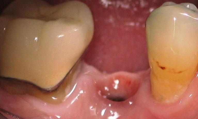 Implant-Replacement-Before-Image
