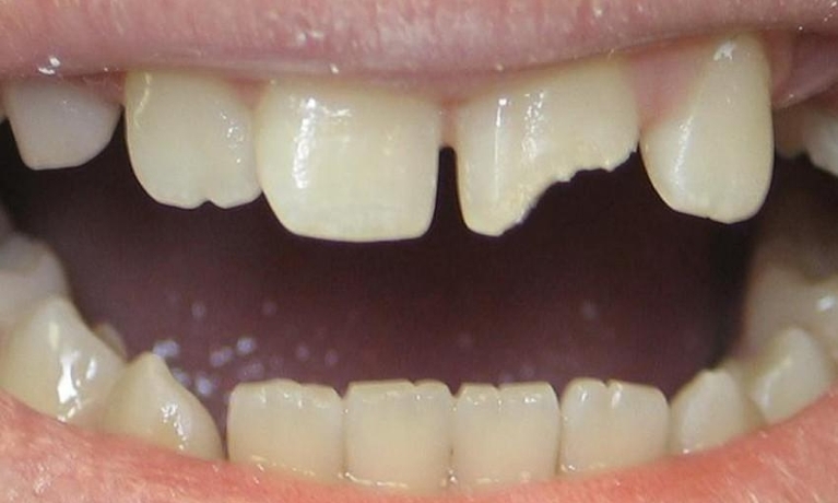 Repair-of-Childs-Broken-Tooth-with-Composite-Before-Image